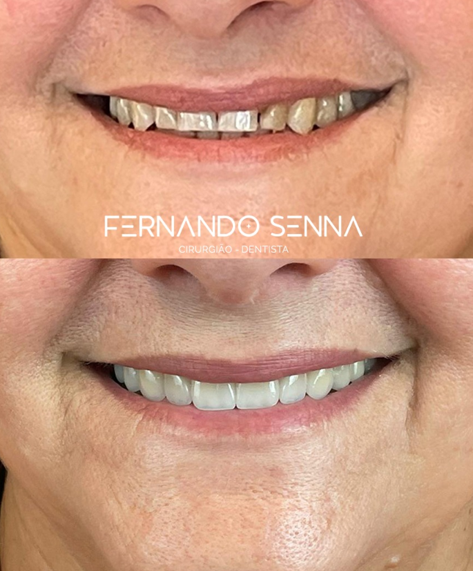 1 ESTÉTICA DENTAL - comparativo